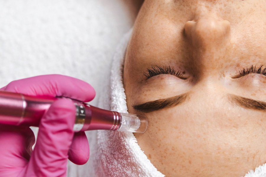 Woman with smooth, even skin tone after a microneedling series