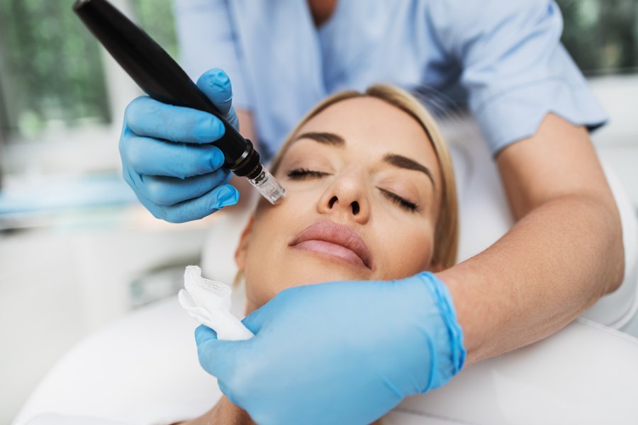 Microneedling treatment — collagen stimulation